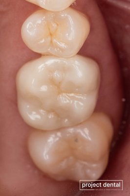 Dental Crown - While small tooth decay can be treated with a filling, large cavities will require more advanced care to restore your tooth, such as a dental crown. Dental Crown - While small tooth decay can be treated with a filling, large cavities will require more advanced care to restore your tooth, such as a dental crown.