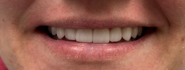 Veneers and Crowns - Cosmetic dentistry is suitable for those who wish to improve how they look when they smile. Fix Imperfections & Brighten Your Smile with Dental Veneers and Crowns. Veneers and Crowns - Cosmetic dentistry is suitable for those who wish to improve how they look when they smile. Fix Imperfections & Brighten Your Smile with Dental Veneers and Crowns.