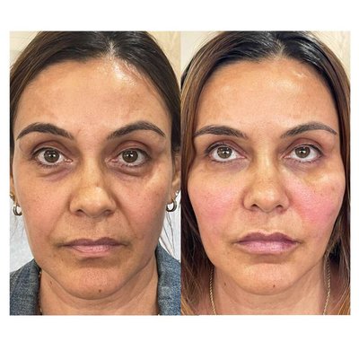 Facial Rejuvenation - Too much sun and poor diet choices affect the tone and texture of your skin and may lead to premature facial aging. But with skin rejuvenation, you don’t have to let your past choices dictate your future look. At Resplendence MedSpa in Beverly Hills, California, Majid Sabour, MD, and the aesthetic team offer many skin rejuvenation treatments. They take a holistic approach to care and work closely with you to design a personalized plan that meets your beauty needs. To schedule your skin rejuvenation consultation, call the Los Angeles office or book online today. Facial Rejuvenation - Too much sun and poor diet choices affect the tone and texture of your skin and may lead to premature facial aging. But with skin rejuvenation, you don’t have to let your past choices dictate your future look. At Resplendence MedSpa in Beverly Hills, California, Majid Sabour, MD, and the aesthetic team offer many skin rejuvenation treatments. They take a holistic approach to care and work closely with you to design a personalized plan that meets your beauty needs. To schedule your skin rejuvenation consultation, call the Los Angeles office or book online today.