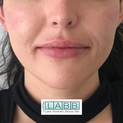 SOUTH BEACH FILLERS and BOTOX MED SPA THE LABB BEAUTY - Enjoy the most innovative and professional treatments performed by our MASTER INJECTORS at The LABB BEAUTY!  Our prices are competitive! We offer you a VIP experience with one chair in our Med Spa for a truly private makeover! Located in the Heart of South Beach. Call #305 934 1391
