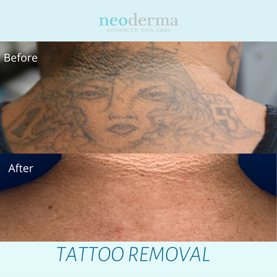 Laser Tattoo Removal - Before and Afters - Tattoos don't have to last a lifetime. At Neoderma Anaheim we offer Picoway laser technology and the Patch to help speed up fading.
Our experience with laser tattoo removal treatments began in 2001. Since then, we’ve performed tens of thousands of laser treatments. How does it work? The laser delivers light at incredibly fast speeds onto the skin. This laser energy, when aimed at tattoo ink, harmlessly passes through the layers of skin to disrupt the ink and break it up into tiny particles.Once the tattoo ink is broken up, the body absorbs the ink naturally and the tattoo fades away. Each treatment does not last very long, and in most cases, is over in a matter of minutes. If you have any questions feel free to contact us anytime. All of our staff is ready to answer any questions you may have. In fact, some of them have even undergone treatments to remove their own tattoos so they understand this process on a very personal basis. Laser Tattoo Removal - Before and Afters - Tattoos don't have to last a lifetime. At Neoderma Anaheim we offer Picoway laser technology and the Patch to help speed up fading.
Our experience with laser tattoo removal treatments began in 2001. Since then, we’ve performed tens of thousands of laser treatments. How does it work? The laser delivers light at incredibly fast speeds onto the skin. This laser energy, when aimed at tattoo ink, harmlessly passes through the layers of skin to disrupt the ink and break it up into tiny particles.Once the tattoo ink is broken up, the body absorbs the ink naturally and the tattoo fades away. Each treatment does not last very long, and in most cases, is over in a matter of minutes. If you have any questions feel free to contact us anytime. All of our staff is ready to answer any questions you may have. In fact, some of them have even undergone treatments to remove their own tattoos so they understand this process on a very personal basis.