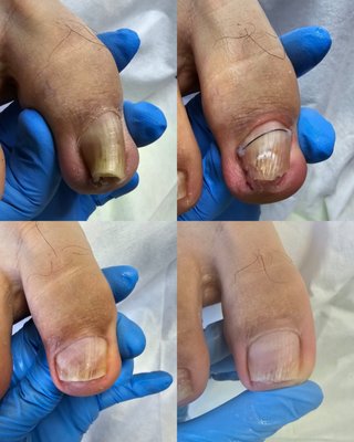 Transformation Triumph: Straightening Success - I'm so thrilled about this transformation!
✅️ we've achieved a perfectly straight nail without any pain or need for surgery.
This success story is a testament to perseverance and determination, proving that with the right care and attention, even the most challenging situations can be overcome. I couldn't be prouder of the progress we've made together! Transformation Triumph: Straightening Success - I'm so thrilled about this transformation!
✅️ we've achieved a perfectly straight nail without any pain or need for surgery.
This success story is a testament to perseverance and determination, proving that with the right care and attention, even the most challenging situations can be overcome. I couldn't be prouder of the progress we've made together!