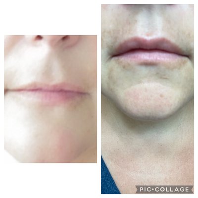 Botox lip flip (before pic on left, after pic on right) - Before and after photos of a Botox Lip Flip Botox lip flip (before pic on left, after pic on right) - Before and after photos of a Botox Lip Flip
