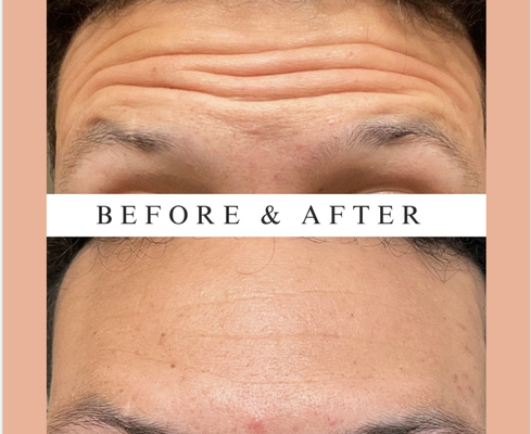 Before and After botox - ✨ Smooth, refreshed skin is just a Botox session away at Glow Haus! ✨
Dysport works by relaxing the muscles that cause fine lines and wrinkles, giving you a youthful, natural look. Sabrina targets areas like the forehead, crow’s feet, and frown lines, tailoring each treatment to your needs.
With minimal downtime and results in just a few days, Botox is the perfect non-surgical way to age gracefully.
Discover your glow at Glow Haus Aesthetics!
#GlowHausMedSpa #BotoxBeauty #AntiAging #WrinkleFree #ConfidenceBoost #YouthfulSkin