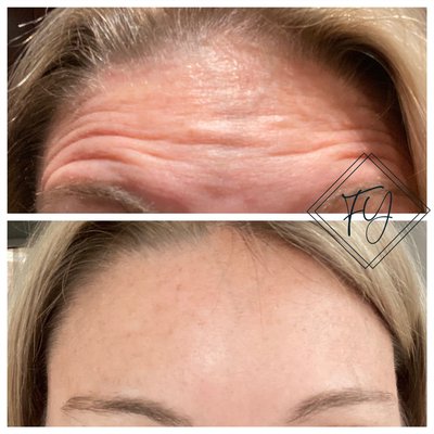 Toxin 💉and Lip filler 💋 - Forever Young Aesthetics is a med spa offering skin rejuvenation treatments and aesthetic injectables by a trained and licensed nurse practitioner. Our goal is to make our clients look and feel forever young