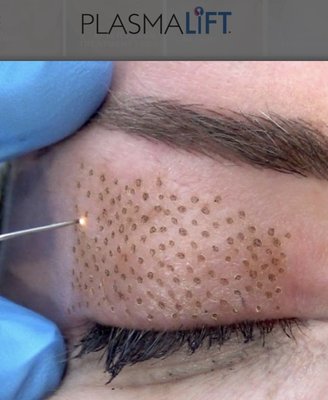 Skin Treatments - If you haven’t heard of plasma lifting, YOU are missing out!! This procedure is a non surgical and noninvasive technique!!! What does it do??
•Repairs the Skin
•Boosts Collagen
•Tightens the Skin
•Lifts the Skin
How does this procedure work??
•A plasma pen creates a small electrical charge to slightly damage the top layer of skin.
•This produces more collagen to repair the damaged skin cells
•New Collagen continues to grow 6-8 weeks after treatment causing the skin to grow back more radiant and smooth!
Other areas that are common for A Plasma Lift are
•Eyelids
•Belly
•Neck
•Arms Skin Treatments - If you haven’t heard of plasma lifting, YOU are missing out!! This procedure is a non surgical and noninvasive technique!!! What does it do??
•Repairs the Skin
•Boosts Collagen
•Tightens the Skin
•Lifts the Skin
How does this procedure work??
•A plasma pen creates a small electrical charge to slightly damage the top layer of skin.
•This produces more collagen to repair the damaged skin cells
•New Collagen continues to grow 6-8 weeks after treatment causing the skin to grow back more radiant and smooth!
Other areas that are common for A Plasma Lift are
•Eyelids
•Belly
•Neck
•Arms