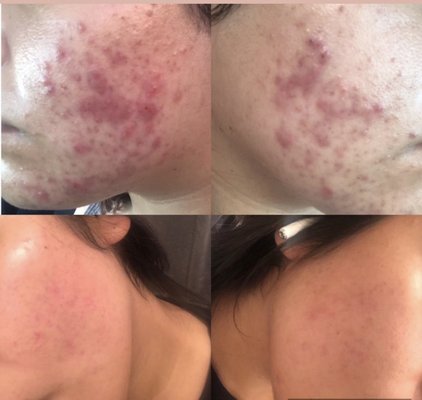 Acne bootcamp Clients - Acne bootcamp is designed as an accelerated program to clear your acne within 12 weeks using Face Reality products and treatments ! As long as you are consistent with bi-weekly treatments and your homecare regimen, this is very feasible, however acne is very unpredictable and can take as long as 6-9 months to become clear depending on the type of acne you have. Acne bootcamp clients will go home with a full routine, master plan to tackle your acne, informative materials and full support and communication so that we can successfully clear your acne.