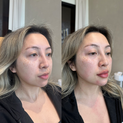 Rumi Refresh - Facial Balancing with a combination of fillers and tox to enhance, contour, lift, and refresh. Rumi Refresh - Facial Balancing with a combination of fillers and tox to enhance, contour, lift, and refresh.