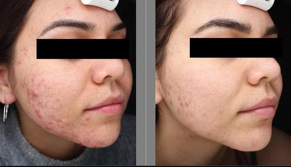 Client Before and Afters - Customized Facial Treatments Client Before and Afters - Customized Facial Treatments