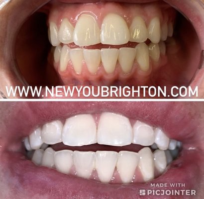 Teeth Whitening - This is a dental grade teeth whitening process that takes your teeth up to 20 shades brighter in less then 1.5 hours from start to finish with an all natural, FDA approved plant based gel that helps protect against sensitivity. Teeth Whitening - This is a dental grade teeth whitening process that takes your teeth up to 20 shades brighter in less then 1.5 hours from start to finish with an all natural, FDA approved plant based gel that helps protect against sensitivity.