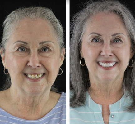 Cosmetic Dentistry, Endodontics, and more... - If you’re seeking a personalized cosmetic dental solution tailored to your unique needs, porcelain veneers might be the perfect choice. These thin, durable shells are custom-crafted from molds of your teeth and are bonded to the front surface, offering a natural appearance that can transform your smile.