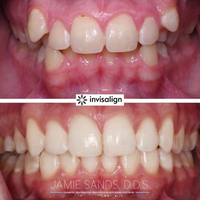 Invisalign - Modern dentistry presents Invisalign® as a new way to successfully straighten teeth without the incessant worry of finding lettuce stuck between the wires.
Using clear, custom-made teeth trays, Invisalign® can correct crooked teeth, gaps, crowding, and bite problems without the pain, discomfort, and unsightly appearance of braces. Straightening your teeth with Invisalign® also improves dental health and reduces the risk of future costly dental problems. Over four million people have already used Invisalign® to achieve a beautiful smile with perfectly straight teeth. Using Invisalign® is a key component of Dr. Sands’ comprehensive smile makeover program which utilizes multiple forms of cosmetic dentistry for a brighter, straighter, and more fulfilling smile. Invisalign - Modern dentistry presents Invisalign® as a new way to successfully straighten teeth without the incessant worry of finding lettuce stuck between the wires.
Using clear, custom-made teeth trays, Invisalign® can correct crooked teeth, gaps, crowding, and bite problems without the pain, discomfort, and unsightly appearance of braces. Straightening your teeth with Invisalign® also improves dental health and reduces the risk of future costly dental problems. Over four million people have already used Invisalign® to achieve a beautiful smile with perfectly straight teeth. Using Invisalign® is a key component of Dr. Sands’ comprehensive smile makeover program which utilizes multiple forms of cosmetic dentistry for a brighter, straighter, and more fulfilling smile.