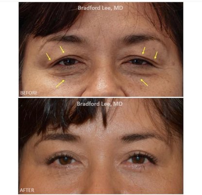 Eyelid Surgery - Procedures like an upper and lower blepharoplasty, brow lift, Asian eyelid surgery, and more can help reverse the effects of time and define your facial features.
Reconstructive surgery like ptosis surgery, ectropion repair, entropion repair, skin cancer surgery, tear duct surgery, orbital fracture repair, and orbital decompression surgery can help improve vision, alleviate pain, correct disfigurement, and restore form and function. Eyelid Surgery - Procedures like an upper and lower blepharoplasty, brow lift, Asian eyelid surgery, and more can help reverse the effects of time and define your facial features.
Reconstructive surgery like ptosis surgery, ectropion repair, entropion repair, skin cancer surgery, tear duct surgery, orbital fracture repair, and orbital decompression surgery can help improve vision, alleviate pain, correct disfigurement, and restore form and function.