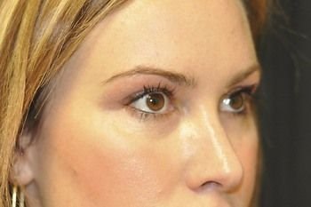 Lower Blepharoplasty - Blepharoplasty on the lower eyelids by Dr. Andrew Smith. 32 year old female patient with some under eye puffiness giving a tired appearance. After the procedure, she looks rested and refreshed.