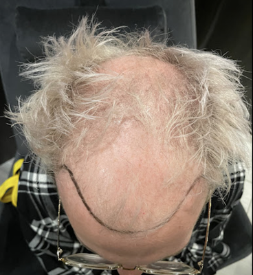 Hair Restoration Results - Discover real hair restoration results from our clients! Hair Restoration Results - Discover real hair restoration results from our clients!