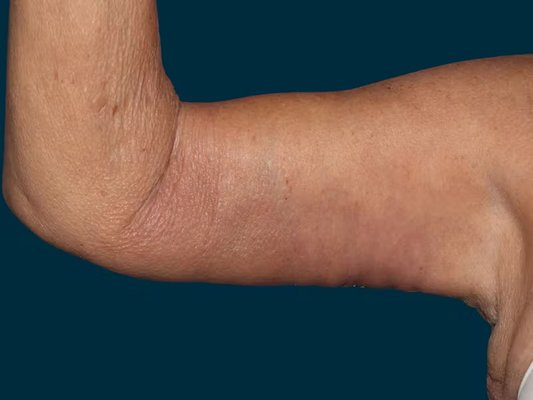 Arm Lift - Arm lift and liposuction performed by Dr. Justin Perez. Patient was age 60, female, and final images were captured at 2 months post-op. Arm Lift - Arm lift and liposuction performed by Dr. Justin Perez. Patient was age 60, female, and final images were captured at 2 months post-op.