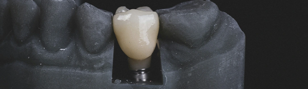 Dental Implants - A dental implant is a permanent restorative solution for a missing tooth. The process involves surgically placing a titanium post into the jawbone to serve as a replacement for the tooth's root. This post becomes secure in the bone through a process called osseointegration, creating a strong foundation for an artificial tooth.
Unlike removable dentures or bridges, dental implants are fixed in place, functioning like natural teeth. This also helps prevent bone loss, maintains the structure of your face, and allows you to eat and speak without worrying about your dental appliance moving. With proper care, a dental implant can last for decades. Dental Implants - A dental implant is a permanent restorative solution for a missing tooth. The process involves surgically placing a titanium post into the jawbone to serve as a replacement for the tooth's root. This post becomes secure in the bone through a process called osseointegration, creating a strong foundation for an artificial tooth.
Unlike removable dentures or bridges, dental implants are fixed in place, functioning like natural teeth. This also helps prevent bone loss, maintains the structure of your face, and allows you to eat and speak without worrying about your dental appliance moving. With proper care, a dental implant can last for decades.