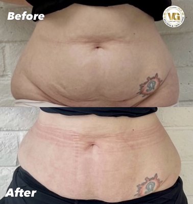 Non-Surgical Body Sculpting - At VitaGlowMD, we offer cutting-edge non-surgical body sculpting solutions to help you achieve your ideal physique. Our signature treatment, Morpheus8, combines microneedling and radiofrequency technology for exceptional body contouring results. This innovative approach targets stubborn areas, effectively reducing cellulite and tightening skin.
Our skilled team understands that each body is unique, which is why we personalize our treatments to meet your specific needs. Whether you’re looking to enhance your curves or smooth out problem areas, our non-invasive techniques deliver impressive results without the downtime associated with surgical procedures.
Experience the transformative benefits of Morpheus8 and our comprehensive body contouring services. Join the many satisfied clients who have achieved their aesthetic goals in a safe and comfortable environment. Schedule a consultation today and discover how we can help you feel more confident in your skin! Non-Surgical Body Sculpting - At VitaGlowMD, we offer cutting-edge non-surgical body sculpting solutions to help you achieve your ideal physique. Our signature treatment, Morpheus8, combines microneedling and radiofrequency technology for exceptional body contouring results. This innovative approach targets stubborn areas, effectively reducing cellulite and tightening skin.
Our skilled team understands that each body is unique, which is why we personalize our treatments to meet your specific needs. Whether you’re looking to enhance your curves or smooth out problem areas, our non-invasive techniques deliver impressive results without the downtime associated with surgical procedures.
Experience the transformative benefits of Morpheus8 and our comprehensive body contouring services. Join the many satisfied clients who have achieved their aesthetic goals in a safe and comfortable environment. Schedule a consultation today and discover how we can help you feel more confident in your skin!