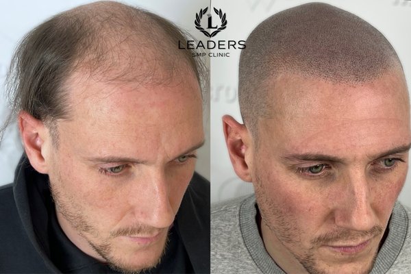 LEADERS ACADEMY AND SMP - Scalp Micropigmentation is changing lives—restoring confidence for burn survivors, those with alopecia, and even enhancing hair transplants! 🙌✨ This is the ultimate solution for hair loss, creating the look of natural, fuller hair with jaw-dropping precision. 🔥💯 And guess what? Leaders Academy can teach YOU how to master this life-changing procedure step by step! 🚀 Whether you’re looking to transform lives or grow your skills, this is your chance to lead the way. Let’s make magic happen! 💪 LEADERS ACADEMY AND SMP - Scalp Micropigmentation is changing lives—restoring confidence for burn survivors, those with alopecia, and even enhancing hair transplants! 🙌✨ This is the ultimate solution for hair loss, creating the look of natural, fuller hair with jaw-dropping precision. 🔥💯 And guess what? Leaders Academy can teach YOU how to master this life-changing procedure step by step! 🚀 Whether you’re looking to transform lives or grow your skills, this is your chance to lead the way. Let’s make magic happen! 💪