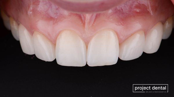 Dental Implants - Replacing your teeth doesn’t need to be inconvenient and filled with uncertainty. At Project Dental, we offer world-class implant treatment right here in Rockville. Dental Implants - Replacing your teeth doesn’t need to be inconvenient and filled with uncertainty. At Project Dental, we offer world-class implant treatment right here in Rockville.