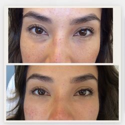 Fillers - TO RESTORE VOLUME LOSS AND ENHANCE YOUTHFUL FACIAL CONTOURS
Over time, age-related volume loss in the face may lead to the reduction of your prominent features such as the jawline, lips, and high cheekbones. Cosmetic Dermal Fillers are FDA-approved fillers that restore volume and help create a smoother and softer appearance. They diminish fine lines and wrinkles by lifting and smoothing your skin.