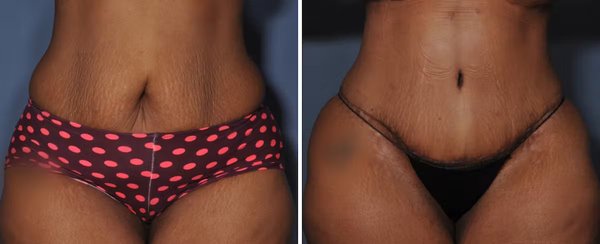 Tummy Tuck - Tummy tuck (abdominoplasty) performed by Dr. Blake Sparks. Tummy Tuck - Tummy tuck (abdominoplasty) performed by Dr. Blake Sparks.