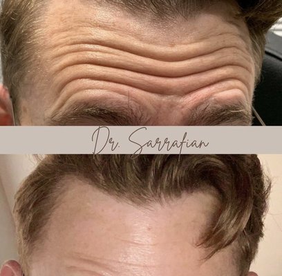 Wrinkle Relaxer - Dr. Sarrafian artfully injected wrinkle relaxers for this patient's forehead and glabella regions to reduce the appearance of wrinkles and combat aging for a more youthful appearance.