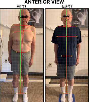 Before and after picture of one of our patients - It's never too late to optimize your posture so you can function better and still enjoy all your favorite activities with your loved one. Before and after picture of one of our patients - It's never too late to optimize your posture so you can function better and still enjoy all your favorite activities with your loved one.