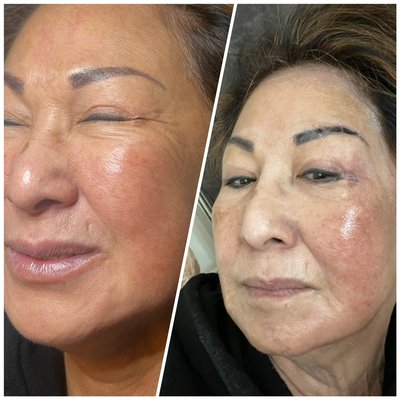 Hyperpigmentation before and after photo - Gena Bradley is a highly skilled skincare professional with extensive expertise in treating various skin concerns. If you're dealing with stubborn melasma, hyperpigmentation, or uneven skin tone, Gena’s personalized treatments can help restore your skin's natural radiance. With her advanced techniques and in-depth knowledge of skincare, she can address your unique needs, guiding you toward smooth, glowing skin. Book your appointment today, and in just 30 days, you’ll start to see remarkable improvements, leaving you with the flawless complexion you’ve always desired. Don’t wait—take the first step toward healthier, more vibrant skin today! Hyperpigmentation before and after photo - Gena Bradley is a highly skilled skincare professional with extensive expertise in treating various skin concerns. If you're dealing with stubborn melasma, hyperpigmentation, or uneven skin tone, Gena’s personalized treatments can help restore your skin's natural radiance. With her advanced techniques and in-depth knowledge of skincare, she can address your unique needs, guiding you toward smooth, glowing skin. Book your appointment today, and in just 30 days, you’ll start to see remarkable improvements, leaving you with the flawless complexion you’ve always desired. Don’t wait—take the first step toward healthier, more vibrant skin today!
