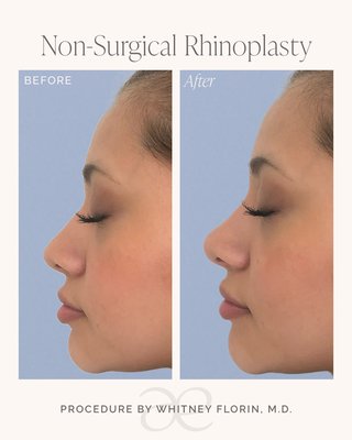 Non-surgical rhinoplasty - Refine the shape of your nose without surgery using advanced dermal filler techniques. A non-surgical rhinoplasty can camouflage a dorsal hump, lift the nasal tip, improve symmetry, refine irregularities following previous surgery, and create a more balanced nasal profile with little to no downtime.
Because the nose is one of the most technically demanding areas to treat with dermal fillers, every non-surgical rhinoplasty at Aesthology is performed exclusively by cosmetic surgeon Dr. Whitney Florin. Careful patient selection, a thorough understanding of nasal anatomy, and meticulous injection technique are essential to achieving beautiful, natural-looking results while prioritizing patient safety. Non-surgical rhinoplasty - Refine the shape of your nose without surgery using advanced dermal filler techniques. A non-surgical rhinoplasty can camouflage a dorsal hump, lift the nasal tip, improve symmetry, refine irregularities following previous surgery, and create a more balanced nasal profile with little to no downtime.
Because the nose is one of the most technically demanding areas to treat with dermal fillers, every non-surgical rhinoplasty at Aesthology is performed exclusively by cosmetic surgeon Dr. Whitney Florin. Careful patient selection, a thorough understanding of nasal anatomy, and meticulous injection technique are essential to achieving beautiful, natural-looking results while prioritizing patient safety.
