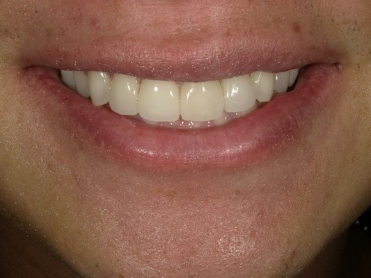 Before& After Veneer Prep - Patient wanted to enhance their smile with 4 veneers. Was achieved with 4 procelin veneers patient was very happy with end result Before& After Veneer Prep - Patient wanted to enhance their smile with 4 veneers. Was achieved with 4 procelin veneers patient was very happy with end result