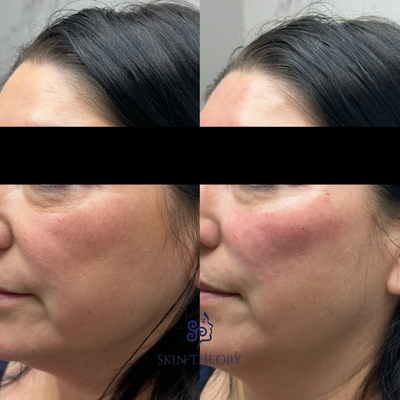 Dermal Fillers - Our dermal filler photo album showcases the remarkable journey from fine lines and wrinkles to smooth, youthful skin. Customized treatments by our expert team enhance facial features with precision, ensuring natural-looking volume and contour restoration. These before-and-after shots reveal the art of subtle enhancement, highlighting the immediate and transformative effects of our fillers. Dermal Fillers - Our dermal filler photo album showcases the remarkable journey from fine lines and wrinkles to smooth, youthful skin. Customized treatments by our expert team enhance facial features with precision, ensuring natural-looking volume and contour restoration. These before-and-after shots reveal the art of subtle enhancement, highlighting the immediate and transformative effects of our fillers.