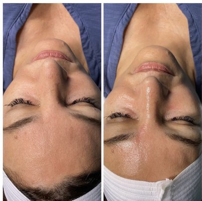 MoonGLO custom facial - This relaxing and rejuvenating facial is custom tailored to your skins needs and what concerns you may have. Will include cleansing, steam, exfoliation, extractions(if needed), LED light therapy, serums, facial masks, light massage, moisturizer, and SPF. MoonGLO custom facial - This relaxing and rejuvenating facial is custom tailored to your skins needs and what concerns you may have. Will include cleansing, steam, exfoliation, extractions(if needed), LED light therapy, serums, facial masks, light massage, moisturizer, and SPF.