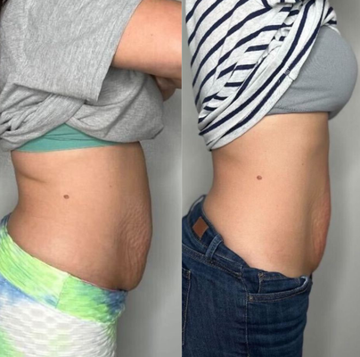 Body contouring - Body contouring Body contouring - Body contouring