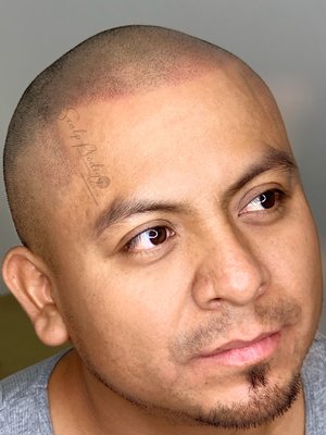 Scalp Micropigmentation - Scalp Micropigmentation at Scalp Prodigy. Scalp Micropigmentation - Scalp Micropigmentation at Scalp Prodigy.
