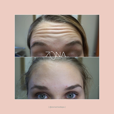 Botox and Dysport Injections at ZONA - Years of repetitive facial movements can leave small creases in the skin, even while resting. These lines and wrinkles can give the appearance of being tired, sad or angry without making any expressions. Small amounts of Botox, Dysport, or Xeomin placed strategically can temporarily relax the muscles and smooth unwanted wrinkles. Untreated areas of the face remain unaffected! ZONA is now offering Cherry Financing to help relieve the financial stress that comes along with aesthetic treatments. Botox and Dysport Injections at ZONA - Years of repetitive facial movements can leave small creases in the skin, even while resting. These lines and wrinkles can give the appearance of being tired, sad or angry without making any expressions. Small amounts of Botox, Dysport, or Xeomin placed strategically can temporarily relax the muscles and smooth unwanted wrinkles. Untreated areas of the face remain unaffected! ZONA is now offering Cherry Financing to help relieve the financial stress that comes along with aesthetic treatments.