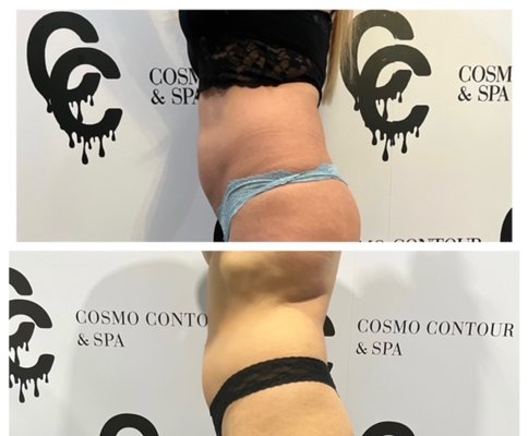Before and After Bodysculpting - WHAT IS VENUS LEGACY?
We use multiple types of medical grade devices to help get each person to their body goals. We customize each package according to your body type! Our treatments are all done with the latest technolgy by Venus™ which is the most advanced Body Contouring technology currently on the market. This revolutionary skin tightening, and cellulite reduction technology delivers safe, pain-free treatments with superior results. Venus™ utilizes 4D™ technology, combining Multi-Polar Radio Frequency (RF), Pulsed Electro Magnetic Fields (PEMF) and VariPulse™ technology (VP), with RealTime Thermal Feedback.
Goal: Body Shaping, Skin Tightening, Fat and Cellulite Reduction Before and After Bodysculpting - WHAT IS VENUS LEGACY?
We use multiple types of medical grade devices to help get each person to their body goals. We customize each package according to your body type! Our treatments are all done with the latest technolgy by Venus™ which is the most advanced Body Contouring technology currently on the market. This revolutionary skin tightening, and cellulite reduction technology delivers safe, pain-free treatments with superior results. Venus™ utilizes 4D™ technology, combining Multi-Polar Radio Frequency (RF), Pulsed Electro Magnetic Fields (PEMF) and VariPulse™ technology (VP), with RealTime Thermal Feedback.
Goal: Body Shaping, Skin Tightening, Fat and Cellulite Reduction