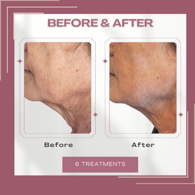 Chin & Jawline - Turn back the hands of time with a defined jawline and no double chin through precision cooling technology that eliminates fat cells safely and permanently. This non-invasive treatment works by freezing fat beneath the skin’s surface, allow your body to naturally process and eliminate it over the following weeks.
Recommended Plan: 6 Session
Results Visible: As early as the second treatment , optimal results between sessions 4 and 6
Ideal for: Perfect for anyone frustrated by double chin fat or an undefined jawline — this treatment restores clean, contoured angles for a more confident profile in photos and real life.
Key Benefits:
Non invasive, no needles, no surgery, no downtime.
Clinically proven Cryolipolosis
EMS Muscle toning sculpts the underlying muscles
Treatment Frequency: Every 14 days Chin & Jawline - Turn back the hands of time with a defined jawline and no double chin through precision cooling technology that eliminates fat cells safely and permanently. This non-invasive treatment works by freezing fat beneath the skin’s surface, allow your body to naturally process and eliminate it over the following weeks.
Recommended Plan: 6 Session
Results Visible: As early as the second treatment , optimal results between sessions 4 and 6
Ideal for: Perfect for anyone frustrated by double chin fat or an undefined jawline — this treatment restores clean, contoured angles for a more confident profile in photos and real life.
Key Benefits:
Non invasive, no needles, no surgery, no downtime.
Clinically proven Cryolipolosis
EMS Muscle toning sculpts the underlying muscles
Treatment Frequency: Every 14 days