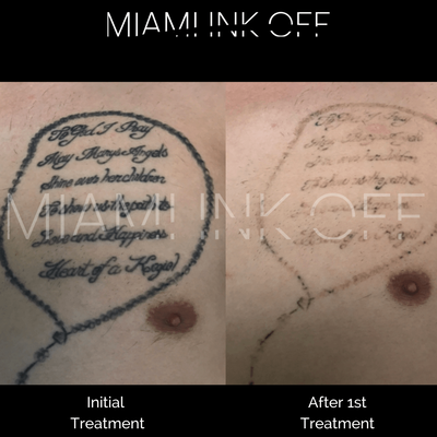 LASER TATTOO REMOVAL - Laser Tattoo Removal – Enlighten III Pico Technology
Miami Skin Spa offers top-tier laser tattoo removal using the Enlighten III, one of the most advanced pico laser systems available today. This technology allows us to safely and effectively treat all ink colors—including stubborn blues, greens, reds, and multicolored tattoos—on all skin tones.
What truly sets us apart: we are one of the few spas in the area offering injectable tumescent anesthesia for tattoo removal. This medical-grade numbing option significantly reduces discomfort, allowing for a virtually pain-free experience, especially for larger, darker, or more sensitive tattoos.
Enlighten III delivers powerful, precise energy that breaks down ink more efficiently—meaning fewer treatments, less frequent sessions, and better overall results compared to older laser systems. Every treatment plan is fully customized based on your tattoo, skin type, and removal goals.
✔ Industry-leading Enlighten III pico technology
✔ Treats all tattoo colors and skin types
✔ Injectable tumescent anesthesia available for minimal to no pain
✔ Fewer sessions needed with more time between treatments
✔ Performed by experienced medical providers
We also offer package discounts and flexible payment plans to make tattoo removal accessible and stress-free. LASER TATTOO REMOVAL - Laser Tattoo Removal – Enlighten III Pico Technology
Miami Skin Spa offers top-tier laser tattoo removal using the Enlighten III, one of the most advanced pico laser systems available today. This technology allows us to safely and effectively treat all ink colors—including stubborn blues, greens, reds, and multicolored tattoos—on all skin tones.
What truly sets us apart: we are one of the few spas in the area offering injectable tumescent anesthesia for tattoo removal. This medical-grade numbing option significantly reduces discomfort, allowing for a virtually pain-free experience, especially for larger, darker, or more sensitive tattoos.
Enlighten III delivers powerful, precise energy that breaks down ink more efficiently—meaning fewer treatments, less frequent sessions, and better overall results compared to older laser systems. Every treatment plan is fully customized based on your tattoo, skin type, and removal goals.
✔ Industry-leading Enlighten III pico technology
✔ Treats all tattoo colors and skin types
✔ Injectable tumescent anesthesia available for minimal to no pain
✔ Fewer sessions needed with more time between treatments
✔ Performed by experienced medical providers
We also offer package discounts and flexible payment plans to make tattoo removal accessible and stress-free.