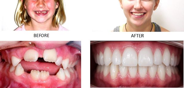 Before and After - Before and After