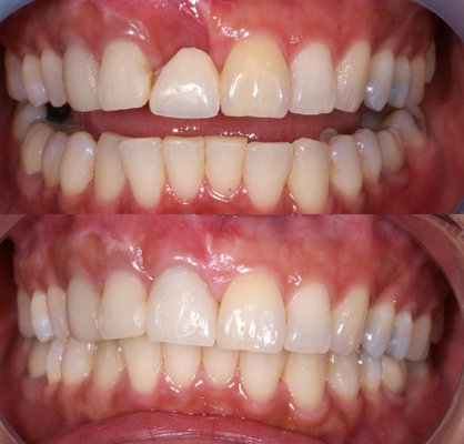 Implants - Implants are used to replace missing or lost teeth, Restoring your confidence, and your ability to eat Implants - Implants are used to replace missing or lost teeth, Restoring your confidence, and your ability to eat
