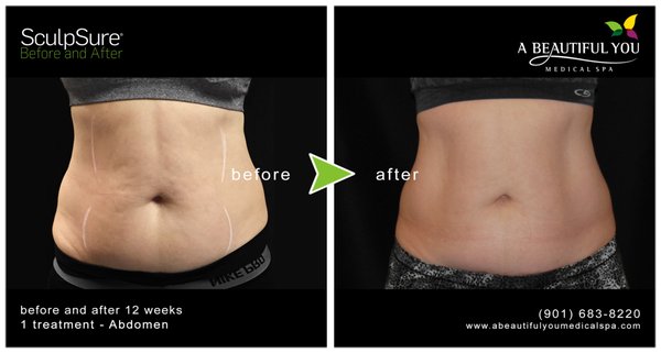 Body Sculpting - Stubborn fat is frustrating. If you’ve tried countless ways to trim and tone your problem areas without getting the results you want, it’s time to talk to the body contouring experts at A Beautiful You Medical Spa in Memphis, Tennessee. They offer noninvasive treatments to get rid of fat and cellulite.