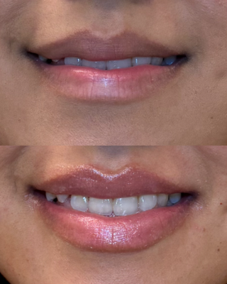 Lip Enhancement Filler - Our patient received a lip filler enhancement designed to add subtle volume while maintaining natural lip shape and balance. The treatment itself typically takes about 30 minutes, and mild swelling can occur immediately after injections as part of the normal healing process. Within a few days, most patients see their lips settle into smooth, natural-looking results. Lip Enhancement Filler - Our patient received a lip filler enhancement designed to add subtle volume while maintaining natural lip shape and balance. The treatment itself typically takes about 30 minutes, and mild swelling can occur immediately after injections as part of the normal healing process. Within a few days, most patients see their lips settle into smooth, natural-looking results.
