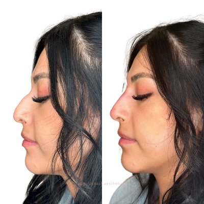 Nose Filler - Non-Surgical Nose Job (Liquid Rhinoplasty, Nose Filler)
Refine your profile—no surgery required.
Our Non-Surgical Nose Job uses precision-placed dermal filler to smooth humps, lift the nasal tip, balance asymmetries, and create the appearance of a straighter, more refined nose—all in under 20 minutes.
Perfect for patients looking to:
✔ Smooth small bumps or dips
✔ Lift or define the tip of the nose
✔ Create a more balanced side profile
✔ Avoid the downtime and cost of a surgical rhinoplasty
Every treatment is customized by Karina, our advanced injector and aesthetics expert, using a “less is more” approach to deliver natural-looking, harmonious results.
✨ Instant results
🕒 Minimal downtime
📆 Results last up to 18-24 months
See why so many of our patients call this their favorite treatment! Nose Filler - Non-Surgical Nose Job (Liquid Rhinoplasty, Nose Filler)
Refine your profile—no surgery required.
Our Non-Surgical Nose Job uses precision-placed dermal filler to smooth humps, lift the nasal tip, balance asymmetries, and create the appearance of a straighter, more refined nose—all in under 20 minutes.
Perfect for patients looking to:
✔ Smooth small bumps or dips
✔ Lift or define the tip of the nose
✔ Create a more balanced side profile
✔ Avoid the downtime and cost of a surgical rhinoplasty
Every treatment is customized by Karina, our advanced injector and aesthetics expert, using a “less is more” approach to deliver natural-looking, harmonious results.
✨ Instant results
🕒 Minimal downtime
📆 Results last up to 18-24 months
See why so many of our patients call this their favorite treatment!