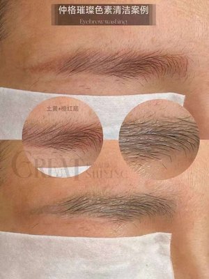 Gentle Eyebrow Tattoo Removal - Experience gentle eyebrow tattoo removal at Way Too Beauty. Our expert technicians ensure a pain-free process with no blood, wounds, or loss of eyebrow hair. With our method, your eyebrows remain intact and won't turn white, restoring your natural look with care and precision. Request a quote today! Gentle Eyebrow Tattoo Removal - Experience gentle eyebrow tattoo removal at Way Too Beauty. Our expert technicians ensure a pain-free process with no blood, wounds, or loss of eyebrow hair. With our method, your eyebrows remain intact and won't turn white, restoring your natural look with care and precision. Request a quote today!