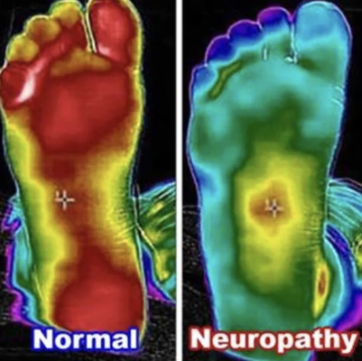 Neuropathy - Neuropathy is a debilitation and ever-worsening condition, often leading to the complete inability to walk and even amputation of the affected extremity.
Utilizing a diverse range of therapies including shockwave, therapy, red light therapy, specific frequencies delivered to the affected tissue, hands-on treatment, supplements, and more, we craft personalized neuropathy treatment plans. Our goal is to effectively alleviate symptoms and enhance nerve health by customizing approaches to individual needs, fostering comprehensive healing. We have a very high (over 90%) success rate. Please call for a free consultation to see if we can help you. Neuropathy - Neuropathy is a debilitation and ever-worsening condition, often leading to the complete inability to walk and even amputation of the affected extremity.
Utilizing a diverse range of therapies including shockwave, therapy, red light therapy, specific frequencies delivered to the affected tissue, hands-on treatment, supplements, and more, we craft personalized neuropathy treatment plans. Our goal is to effectively alleviate symptoms and enhance nerve health by customizing approaches to individual needs, fostering comprehensive healing. We have a very high (over 90%) success rate. Please call for a free consultation to see if we can help you.