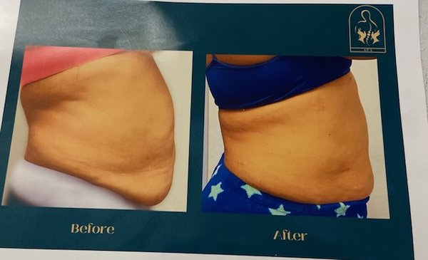 Body contouring - Non-surgical body contouring is an umbrella term for non-invasive procedures that reduce fat, tighten the skin, bulk up muscle, or offer a combination of each. Body contouring helps shape the body and address specific areas where weight loss is not effective. Sculpture’s laser elevates the temperature of fat cells to damage their structural integrity. The body’s natural processes will gradually remove the dead fat cells. In about 30 minutes, Sculpture treats a large area. Body contouring - Non-surgical body contouring is an umbrella term for non-invasive procedures that reduce fat, tighten the skin, bulk up muscle, or offer a combination of each. Body contouring helps shape the body and address specific areas where weight loss is not effective. Sculpture’s laser elevates the temperature of fat cells to damage their structural integrity. The body’s natural processes will gradually remove the dead fat cells. In about 30 minutes, Sculpture treats a large area.