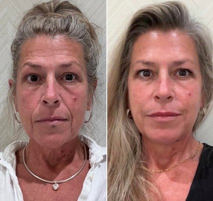Before & Afters - Full-Face Rejuvenation | Natural-Looking Results in Sarasota & Venice

These before-and-after transformations from Eternal MedSpa highlight a medically guided, full-face approach to facial rejuvenation. Each result reflects a personalized treatment plan designed around the guest’s anatomy, goals, facial balance, and long-term skin health.

At Eternal MedSpa in Sarasota and Venice, we offer advanced aesthetic treatments including wrinkle relaxers such as Botox, Dysport, Xeomin, and Letybo; dermal fillers including Restylane, Juvederm, RHA, and Radiesse; medical-grade skincare; and permanent makeup.

Wrinkle Relaxers
Botox, Dysport, Xeomin, and Letybo help soften dynamic expression lines in areas such as the forehead, frown lines, and crow’s feet. The goal is a smoother, more refreshed appearance while maintaining natural facial expression.

Dermal Fillers
Restylane, Juvederm, RHA, and Radiesse fillers can restore lost volume, enhance facial contours, improve symmetry, and support natural-looking facial balance. Common treatment areas include the cheeks, lips, jawline, chin, nasolabial folds, and under-eye area. Our approach focuses on subtle, refined results—not an overfilled look.

Medical-Grade Skincare
Professional skincare, including brands such as SkinCeuticals and Hydrinity, helps improve skin tone, texture, hydration, brightness, and overall skin quality. Skincare is often an essential part of maintaining and enhancing in-office treatment results.

Permanent Makeup
Permanent makeup services such as brows and lip blushing can enhance natural definition, improve symmetry, and simplify your daily routine while keeping results soft and natural.

What sets Eternal MedSpa apart is our commitment to safety, precision, transparency, and elevated care. Our experienced providers create customized treatment plans using evidence-based protocols, physician oversight, and a focus on natural-looking outcomes.

These transformations are not about looking different. They are about looking more refreshed, balanced, confident, and like the best version of yourself.

If you are searching for Botox in Sarasota, dermal fillers in Venice, lip filler, cheek filler, wrinkle relaxers, medical-grade skincare, permanent makeup, or a trusted med spa near you, Eternal MedSpa offers a refined, medically guided experience in Sarasota and Venice, Florida.