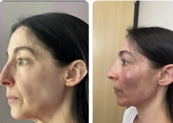 Derma Filler Specialists - Welcome to DrippyNurseJess Med Boutique, where aesthetic enhancement meets wellness. Owned and operated by Nurse Jess, our boutique specializes in Dermal Fillers but extends to a comprehensive suite of services tailored to your beauty and health needs.

Our Specialties:
Dermal Fillers: At the heart of our offerings, we provide top-tier dermal filler services to restore volume, smooth wrinkles, and enhance facial contours. Nurse Jess, with her extensive background in surgical services, including Plastics/Reconstructive surgery, ensures personalized treatment plans that align with your aesthetic goals.

Additional Services:
IV Therapy: Elevate your health with our range of IV therapies designed to hydrate, detoxify, and boost your immune system.
Wellness Shots: Quick, effective injections to support various health aspects like energy, immunity, and recovery.
Aesthetics: Beyond fillers, we offer treatments like Jeuveau, Dysport, Botox, and various injectables to help you look and feel your best.

Why Choose Us?
Personalized Care: Each client receives a bespoke plan, acknowledging their uniqueness. Nurse Jess's philosophy centers around integrating aesthetic enhancement with wellness practices to nurture not just the body but also the spirit and mind.
Expertise: With a background spanning multiple surgical specialties, Nurse Jess brings a wealth of knowledge, ensuring safe, effective, and beautiful results.
Affordability & Inclusivity: We are committed to making aesthetic and wellness services accessible, striving to make these essential treatments inclusive for everyone in the Bay Area.