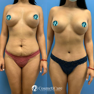 Body Contouring - Factors such as genetics, past pregnancy, and significant weight loss all can conspire to create a protruding tummy and the dreaded “stretch marks” that only surgery can address. If this sounds like you, a tummy tuck, or “abdominoplasty” procedure, can help you enjoy a trim and toned abdomen by removing excess skin and fat while tightening overstretched muscles in a way no amount of exercise ever could.
You’ll enjoy a more attractive body silhouette and all the confidence that comes along with it. To learn more about how the tummy tuck or other body contouring procedures can help you, reach out to the CosmetiCare team at our Newport Beach location and set up your consultation with a member of our team today. Body Contouring - Factors such as genetics, past pregnancy, and significant weight loss all can conspire to create a protruding tummy and the dreaded “stretch marks” that only surgery can address. If this sounds like you, a tummy tuck, or “abdominoplasty” procedure, can help you enjoy a trim and toned abdomen by removing excess skin and fat while tightening overstretched muscles in a way no amount of exercise ever could.
You’ll enjoy a more attractive body silhouette and all the confidence that comes along with it. To learn more about how the tummy tuck or other body contouring procedures can help you, reach out to the CosmetiCare team at our Newport Beach location and set up your consultation with a member of our team today.